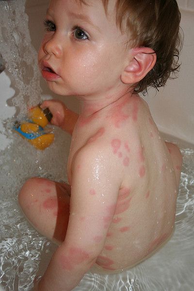 Rumień zakaźny to problem zdrowotny małych dzieci, ale i dorosłych.