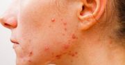 Trądzik młodzieńczy - skąd się bierze i jak zwalczyć ten rodzaj trądziku?