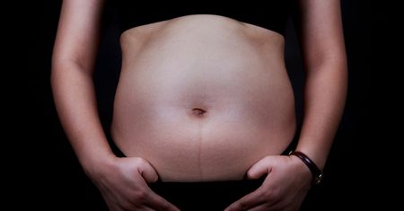 Rozstęp mięśni brzucha po porodzie - przyczyny. Ćwiczenia na brzuch po ciąży